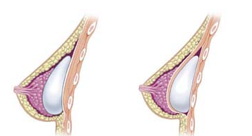 220px-Breast_implants-Implant Pocket Placement